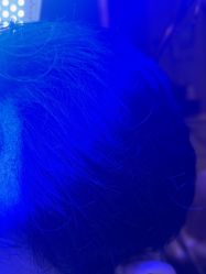 -碧莲盛·不剃发植发