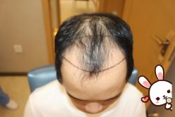 -大麦微针植发丨全国连锁