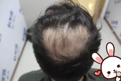 -大麦微针植发丨全国连锁