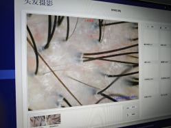 -菩叶脱发白发中心