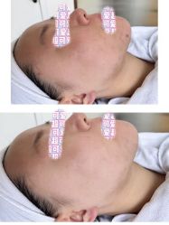 -时光畔·酷雪·痘肌