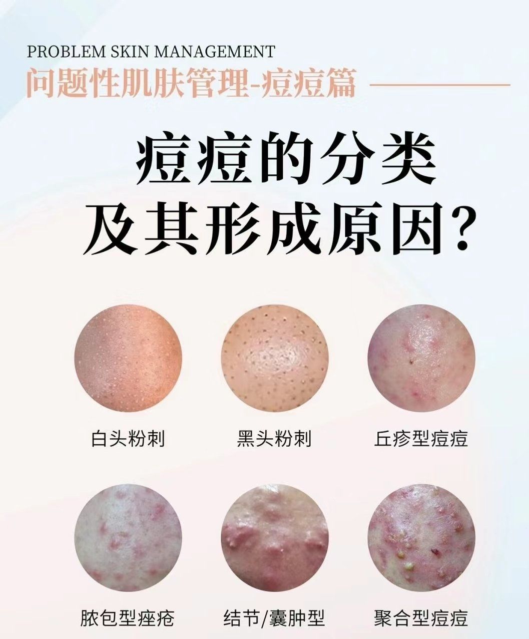 不同类型的痘痘又是如何形成?
痘痘是一种常见的