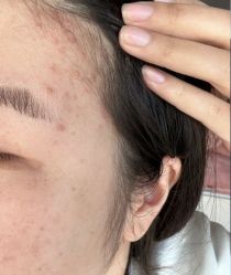 -成都苗方清颜专业祛痘