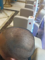 -碧莲盛·不剃发植发