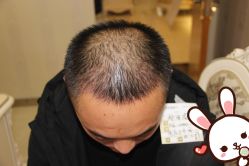 点击看大图 -大麦微针植发丨全国连锁