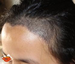 -大麦微针植发丨全国连锁