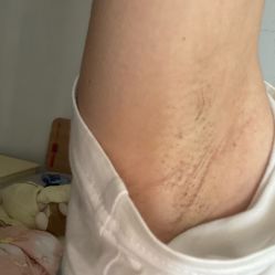 体验后-嘉和医学脱毛中心