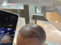 -碧莲盛·不剃发植发