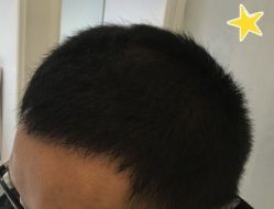 -大麦微针植发丨全国连锁