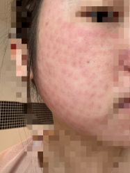 -海涛医疗美容·面部抗衰·注射美鼻