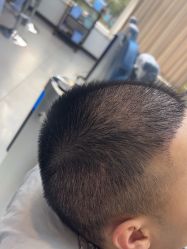 -大麦微针植发全国连锁