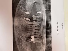 -上海仁爱医院口腔科 · 种植