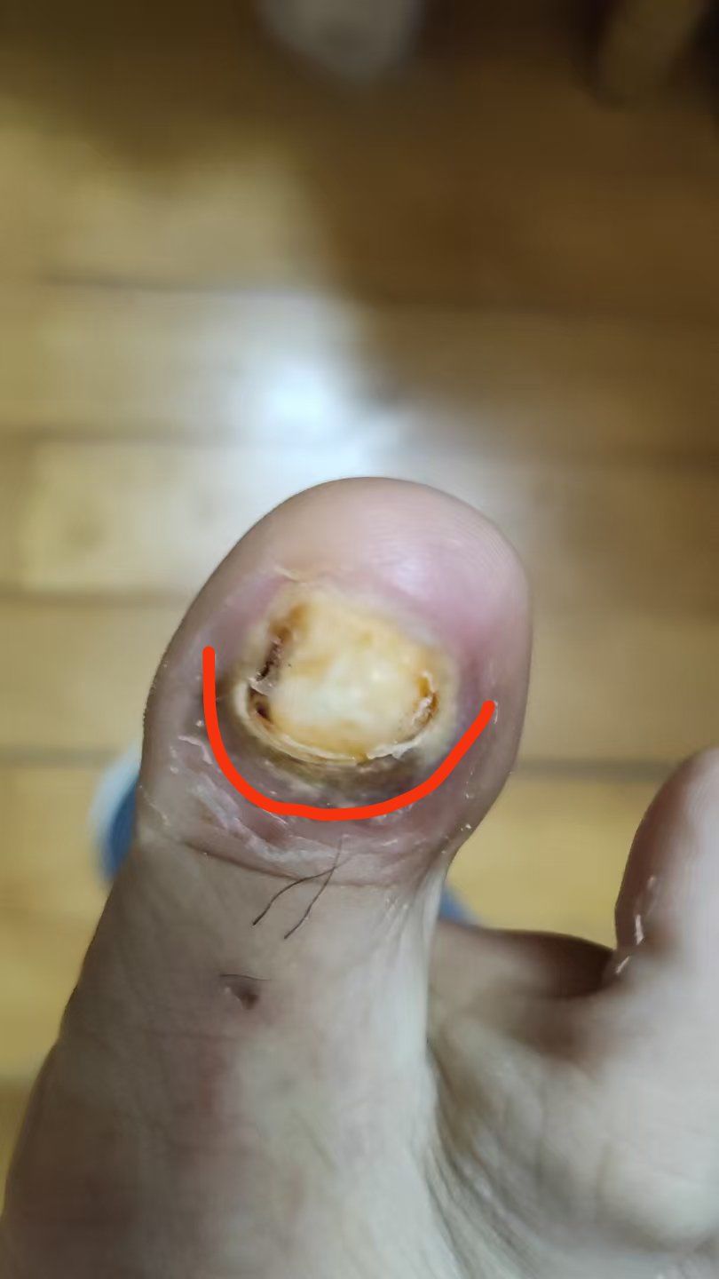 为什么会长灰指甲什么原因造成的为什么在线 为什么会长灰指甲什么原因造成的为什么在线