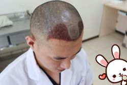 -大麦微针植发丨全国连锁