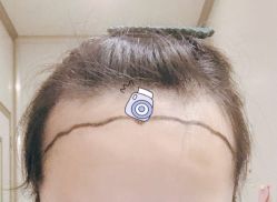 -大麦微针植发全国连锁