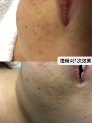 体验前-痘敏医生专业祛痘·肌肤修复连锁
