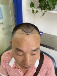 体验前-大麦微针植发全国连锁