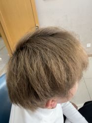 -大麦微针植发丨全国连锁