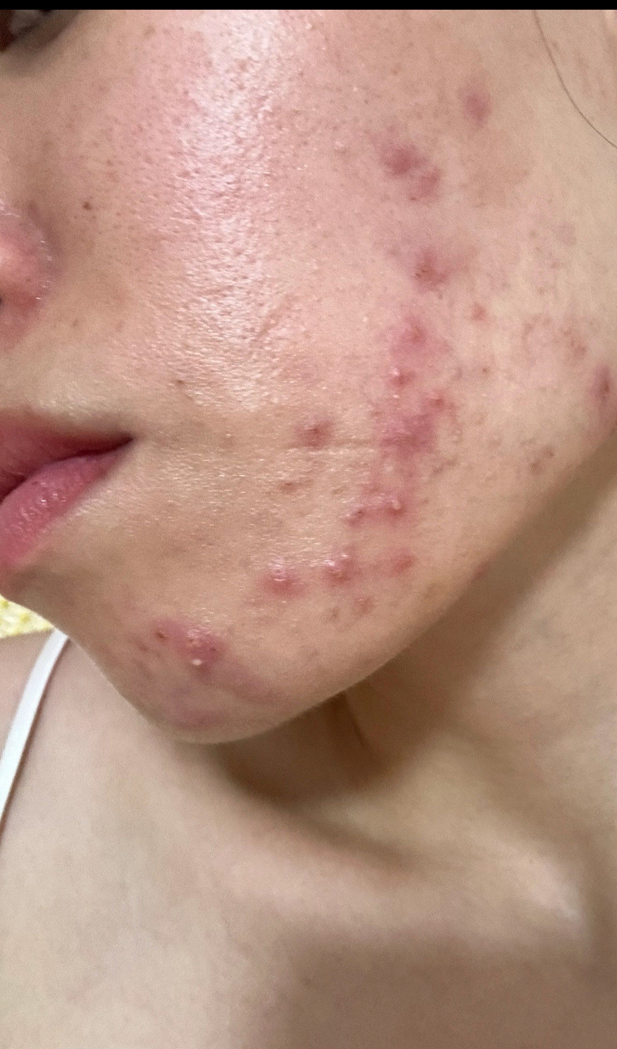 看看这脸上的痘痘都发炎了,夏天是痘痘的高