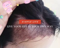 -大麦微针植发全国连锁