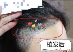 -大麦微针植发全国连锁