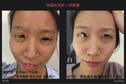 水光针-光SPA科技美肤