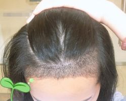 -大麦微针植发丨全国连锁