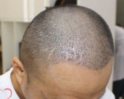 -大麦微针植发丨全国连锁