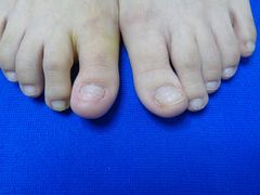 -世龙世家甲沟炎·灰指甲·嵌甲矫正·修脚(武侯区双楠店)