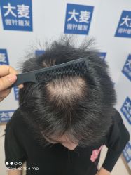 -大麦微针植发丨全国连锁