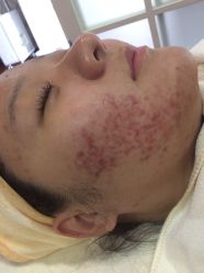 -苗方清颜专业祛痘