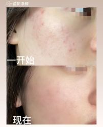 -苗坊净颜痘斑美容护肤连锁