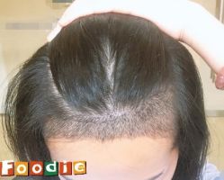 -大麦微针植发丨全国连锁