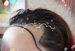 -大麦微针植发全国连锁