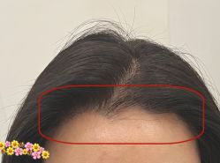 -大麦微针植发全国连锁