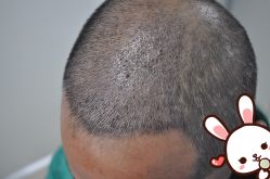 点击看大图 -大麦微针植发丨全国连锁