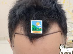 -大麦微针植发全国连锁