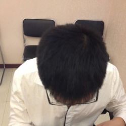 -碧莲盛·不剃发植发