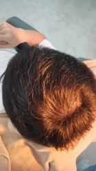 点击看大图 -大麦微针植发丨全国连锁