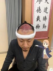 -大麦微针植发丨全国连锁