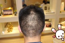 -大麦微针植发丨全国连锁