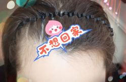 -大麦微针植发全国连锁