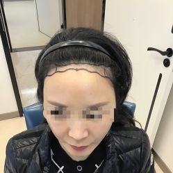 点击看大图 -大麦微针植发丨全国连锁