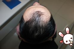 -大麦微针植发丨全国连锁