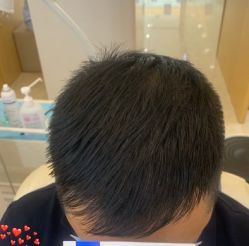 -大麦微针植发丨全国连锁