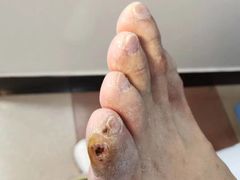 -世龙世家灰指甲鸡眼脚气甲沟炎跖疣护理(通州店)