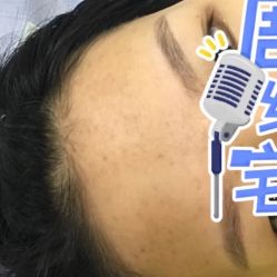 -成都苗方清颜专业祛痘