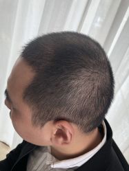 点击看大图 -大麦微针植发丨全国连锁