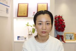 点击看大图 -大麦微针植发丨全国连锁