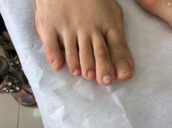 -德哥灰指甲脚气甲沟炎跖疣护理
